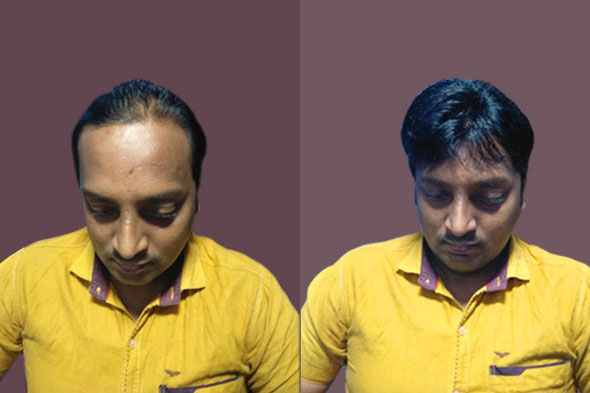Needs Hair Studio in Sri Nagar Colony,Hyderabad - Best Hair Transplant  Clinics in Hyderabad - Justdial