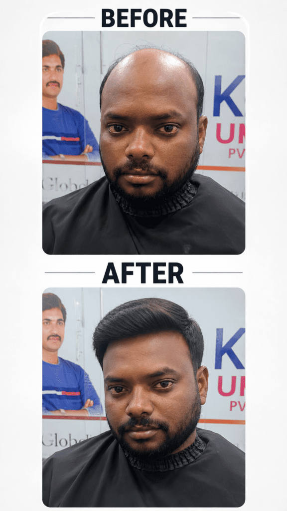 Hair Bonding in Hyderabad