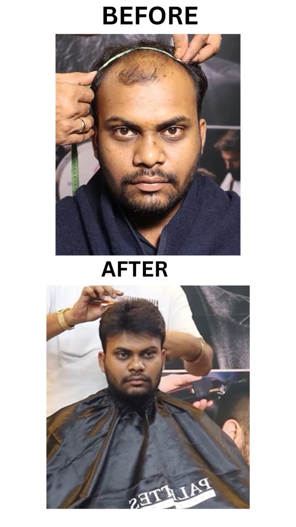 Non-Surgical Hair Replacement