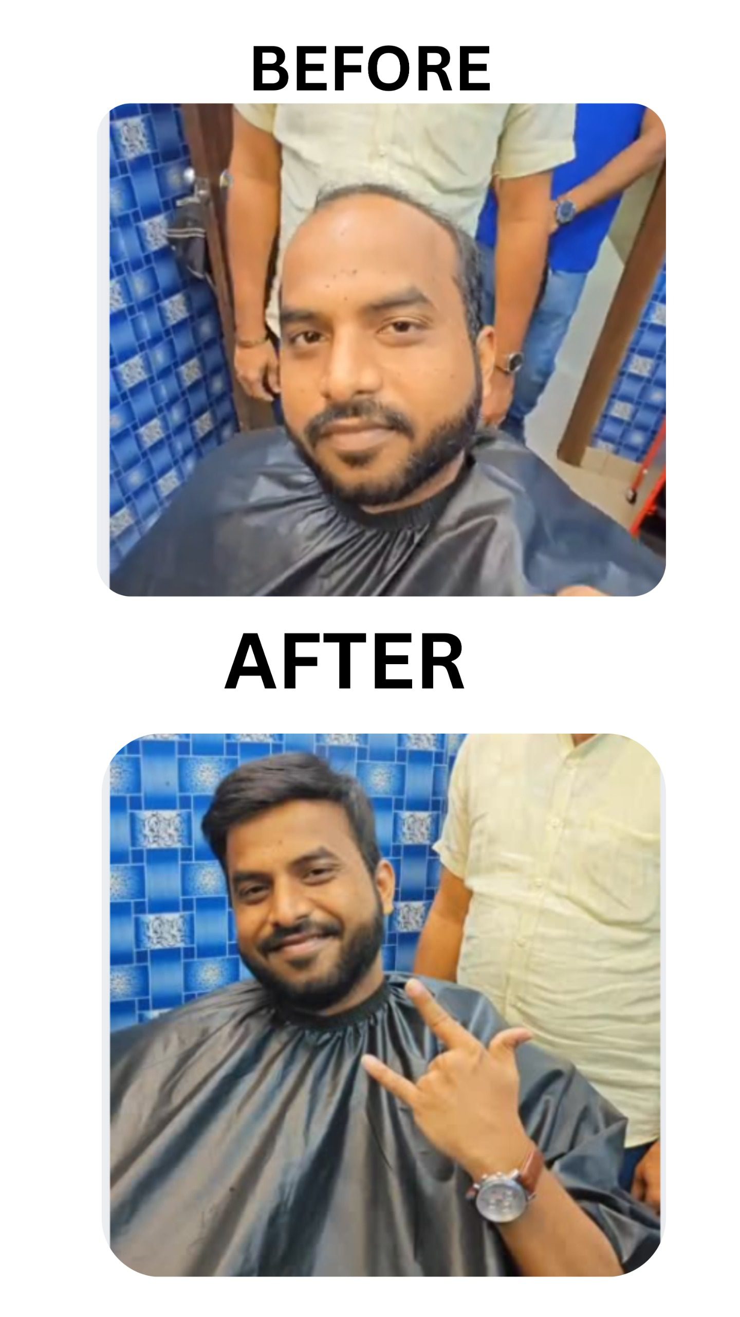 Best Solution for Baldness Without Surgery