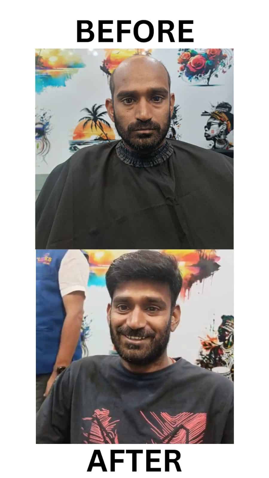 Non-Surgical Hair Replacement in Hyderabad