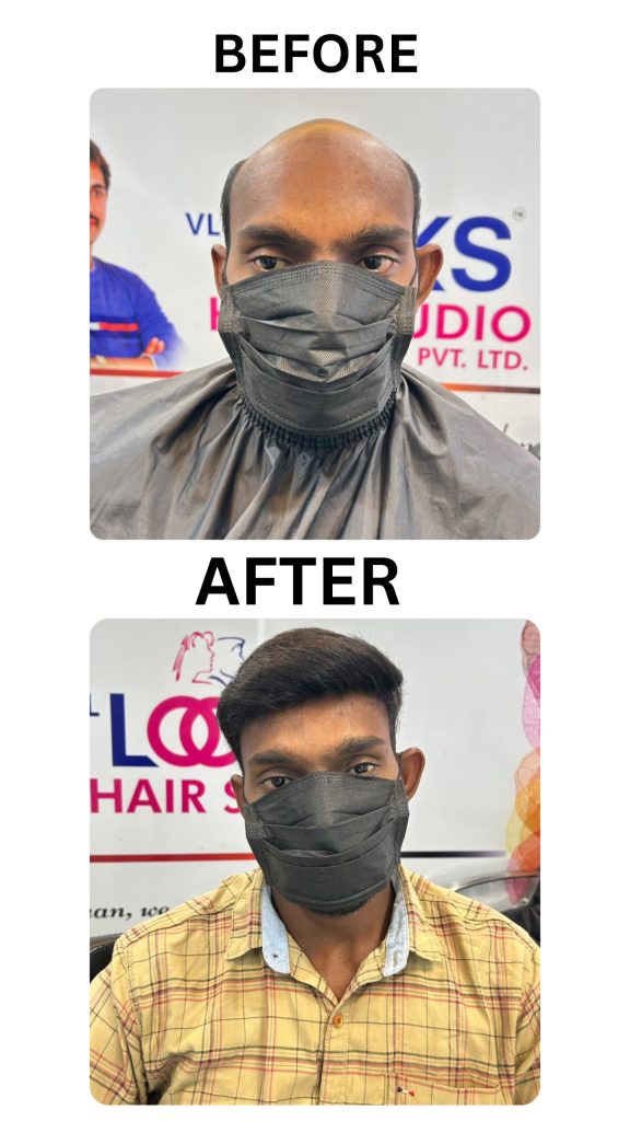 Non Surgical Hair Replacement before and after