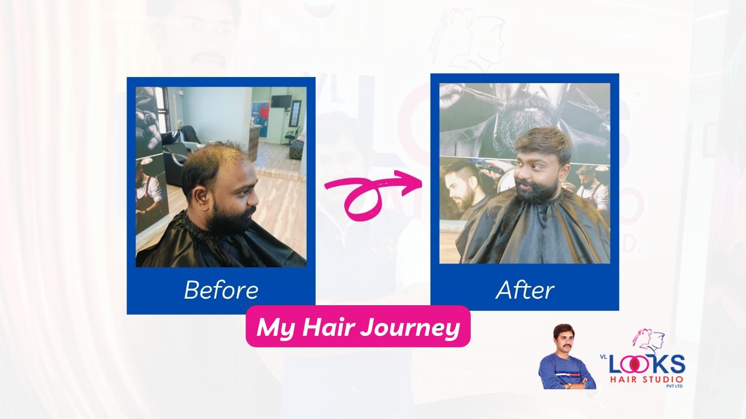 LOOKS- NON SURGICAL HAIR REPLAC EMENT