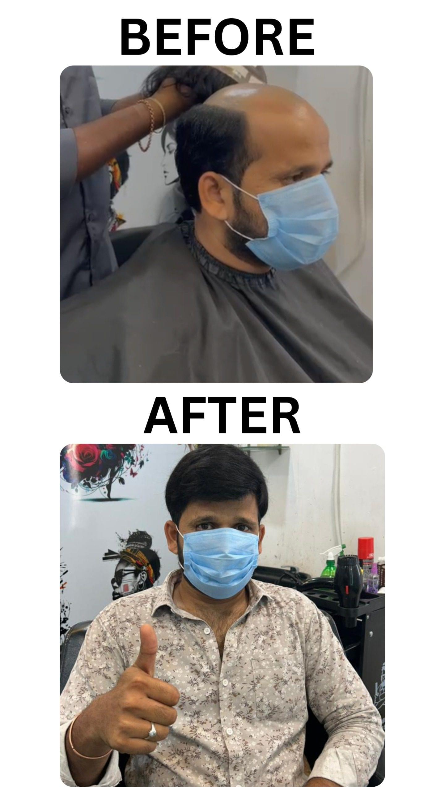 Top 7 Myths About Non Surgical Hair Replacement